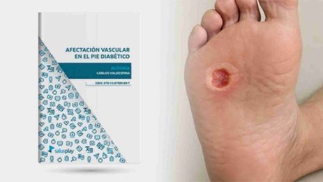 Nuevo ebook descargable: “Afectación vascular en el pie diabético”